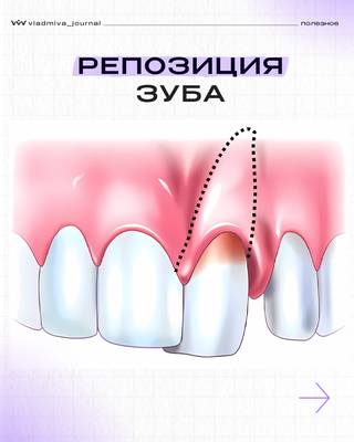 Вывих зуба: репозиция до развития кисты.